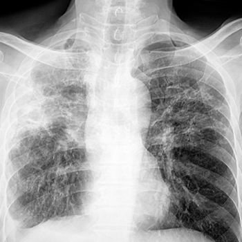Röntgenbild Lunge Tuberkulose iStock Sopone Nawoot.jpg